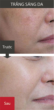 vinhy-j1-premium-trang-sang-da