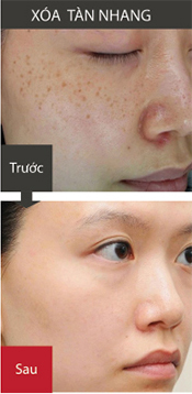 vinhy-j1-premium-xoa-tan-nhang