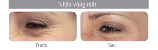 D(iều trị trước sau máy xóa nhăn vùng mắt