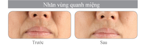vinhy-hipro-nhan-vung-quanh-mieng