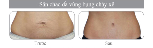 vinhy-san-chac-da-vung-bung-chay-xe-2