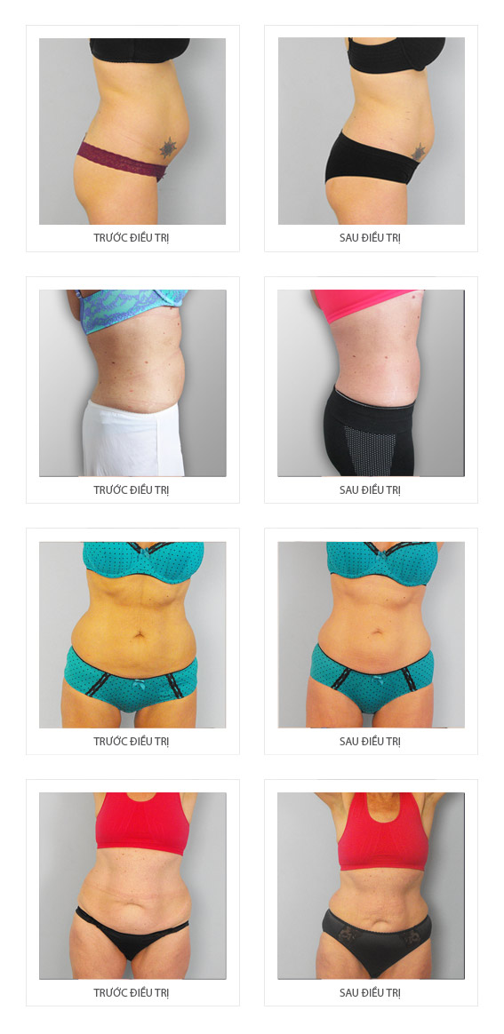 xero-lipo-dieu-tri-vung-bung-va-eo