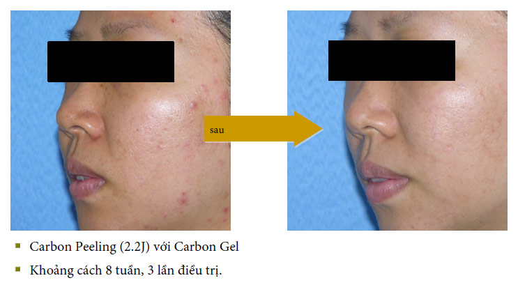 vinhy-carbon-gel-ket-qua-dieu-tri-1