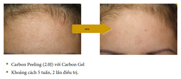 vinhy-carbon-gel-ket-qua-dieu-tri-2