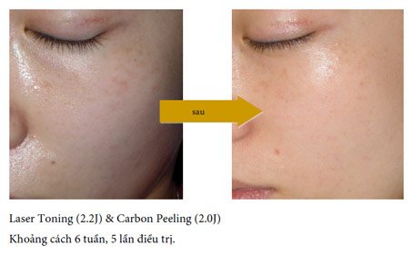 vinhy-carbon-gel-ket-qua-dieu-tri-3