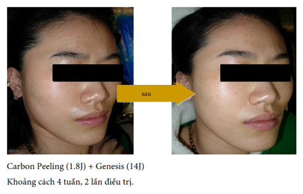 vinhy-carbon-gel-ket-qua-dieu-tri-4