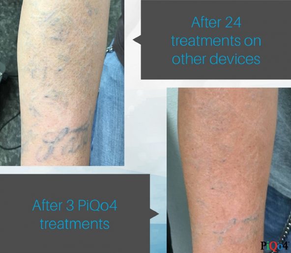 nhung-hinh-xam-duoc-loai-bo-bang-may-laser-xoa-xam-cua-my-1-min-1