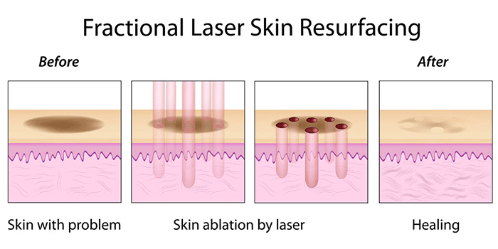 laser-resurfacing