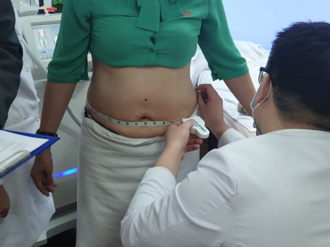 Đo vùng bụng khách hàng trước khi điều trị bằng máy giảm béo