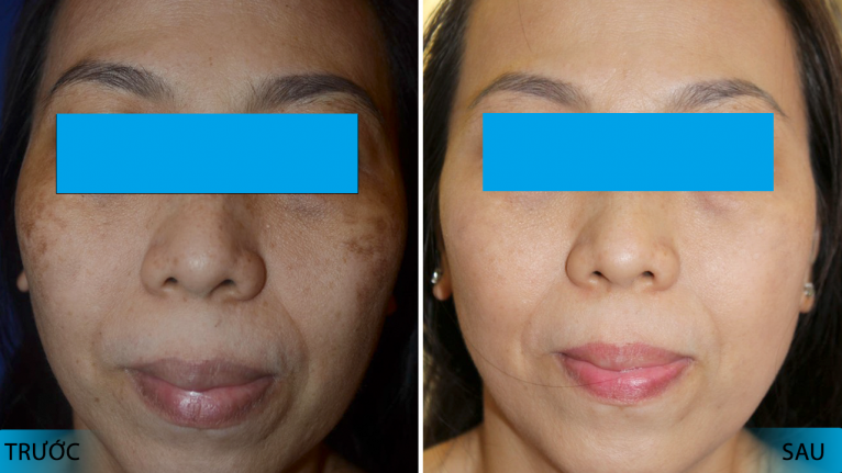 Trước và sau khi điều trị bằng máy điều trị nám da